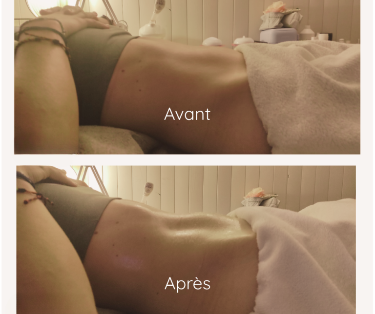 Avant après drainage ventre